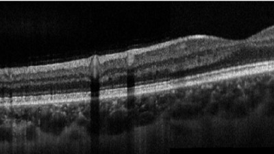 Optical coherence tomography (OCT)